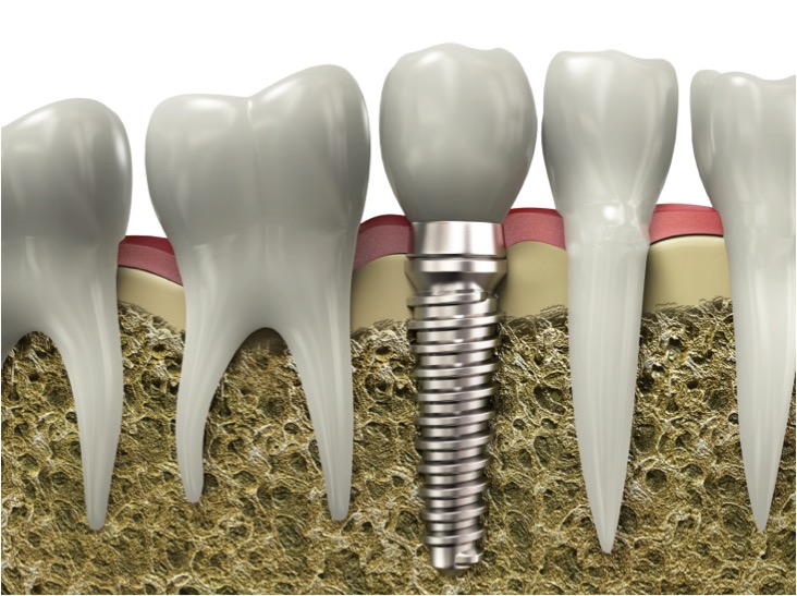 Implante-Dental-Prepagas