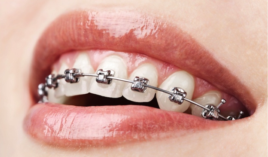 Brackets-Metalicos-Ortodoncia